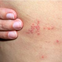 image of bed bug bites