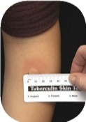 picture of an arm with an induration from a TST and a hand measuring it